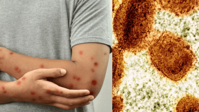 MPOX
